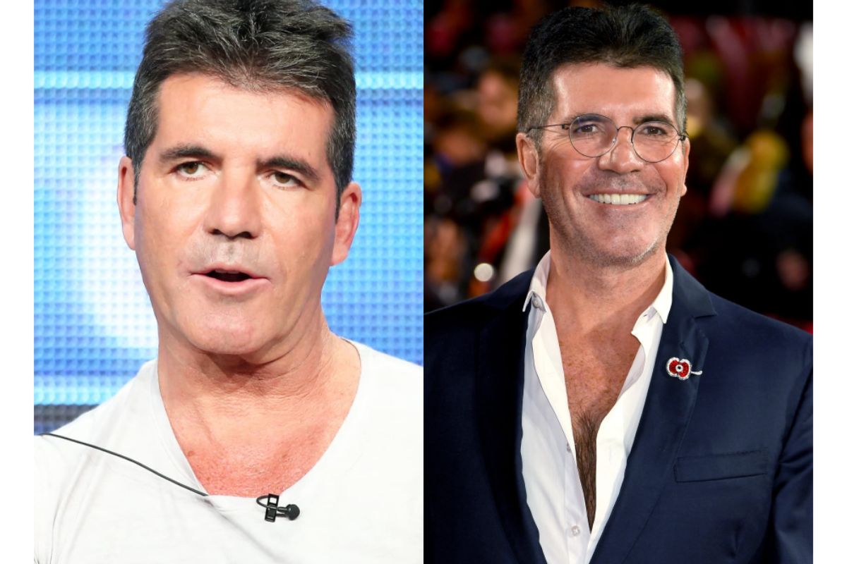Images of Simon Cowell's Before and After Plastic Surgery