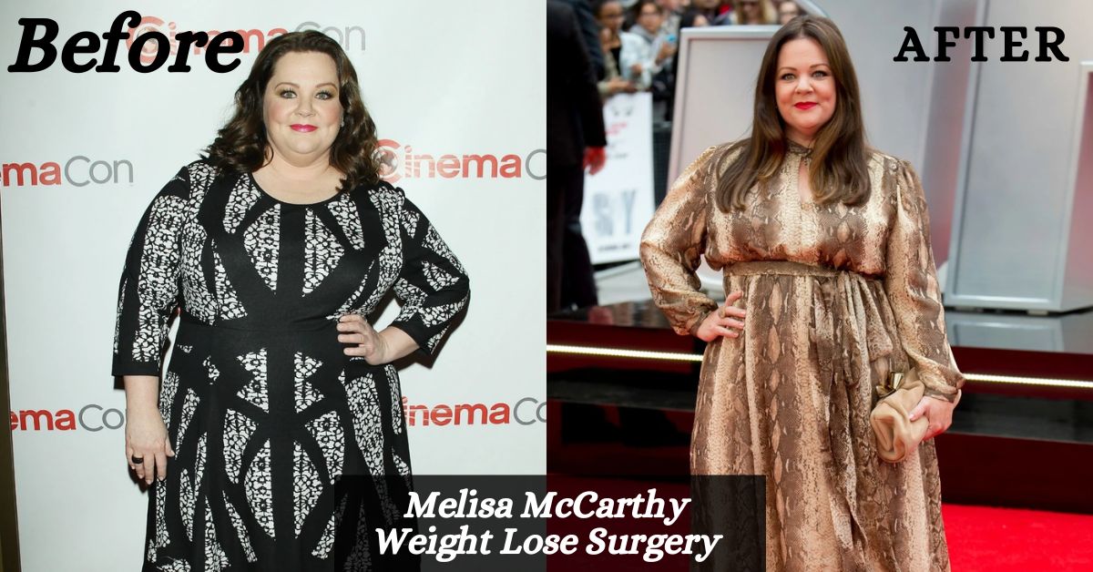 Did Melissa McCarthy Have Weight Loss Surgery?