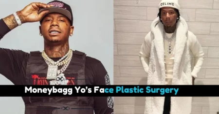 Moneybagg Yo’s Face Plastic SurgeryMoneybagg Yo’s Face Plastic Surgery