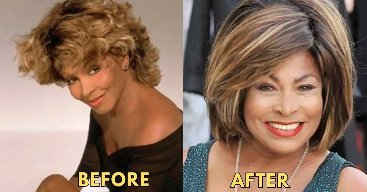 Tina Turner Plastic Surgery