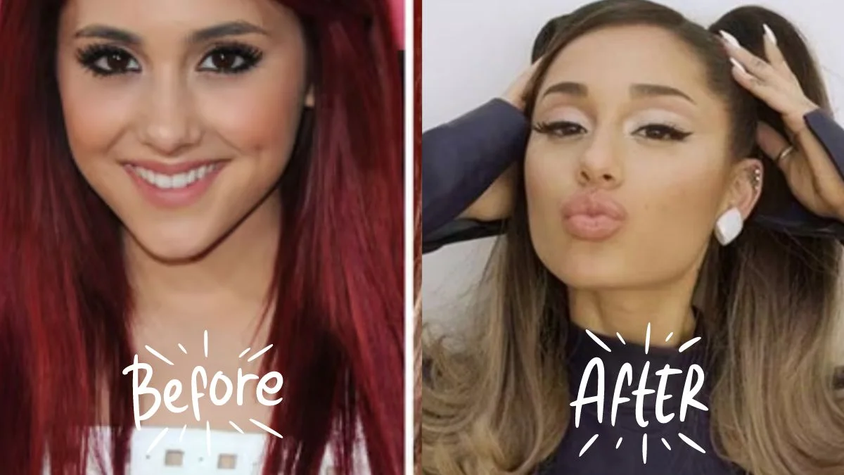 Ariana Grande Lip Fillers
