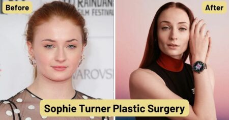 Sophie Turner Plastic Surgery