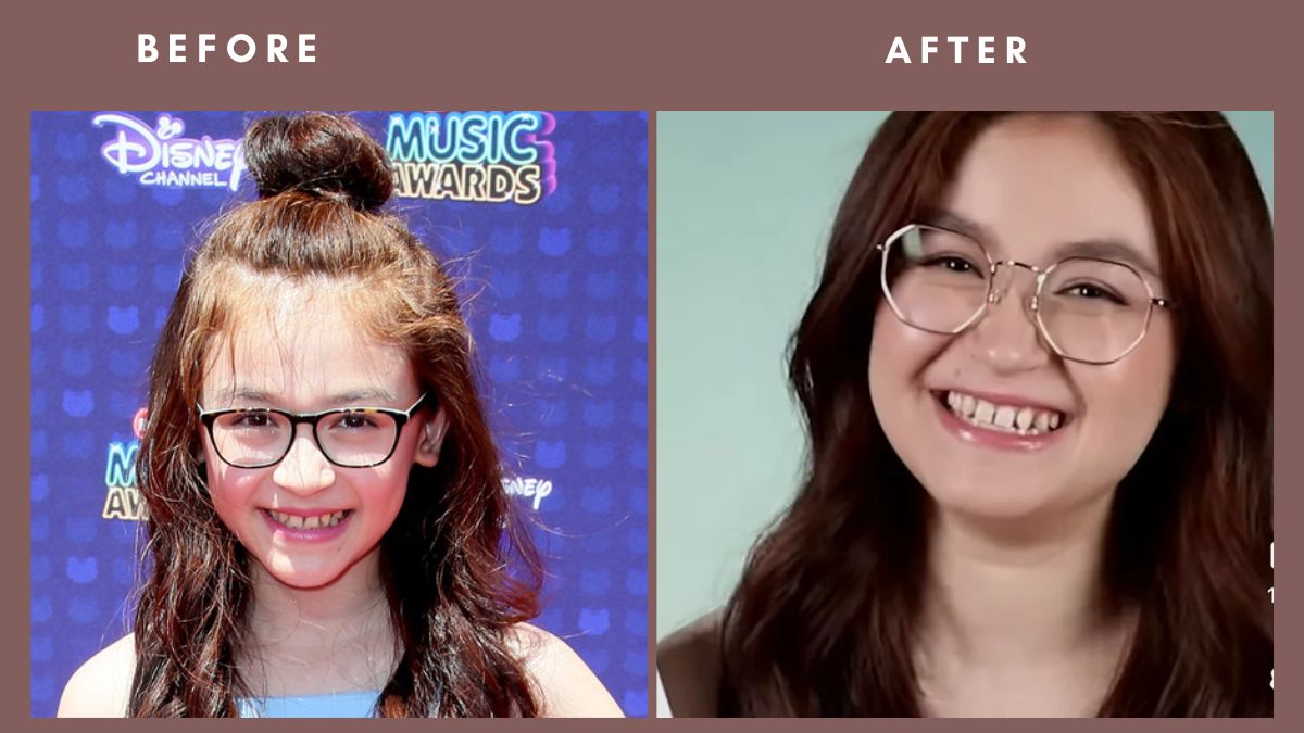 Anna Cathcart Before and After Teeth